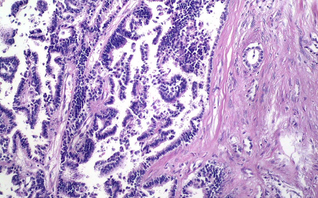 Diversidad genética del cáncer de pulmón